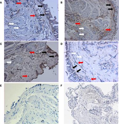 Increased Autophagy-Related 5 Gene Expression Is Associated with Collagen Expression in the Airways of Refractory Asthmatics